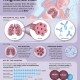 RSV Infographic