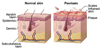psoriasis-treatment options